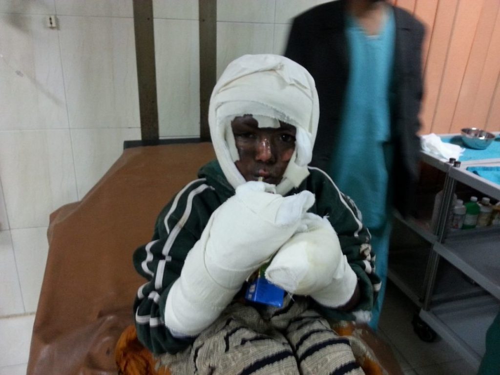 Burn victim under treatmen at BCC in PIMS Islamabad : Photo by News Lens Pakistan/